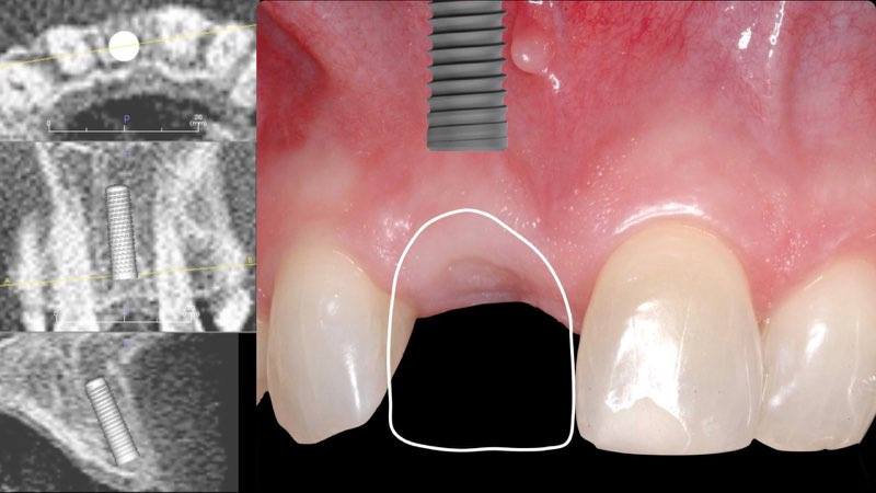 Surgical guide showing dental implant and dental crown shape