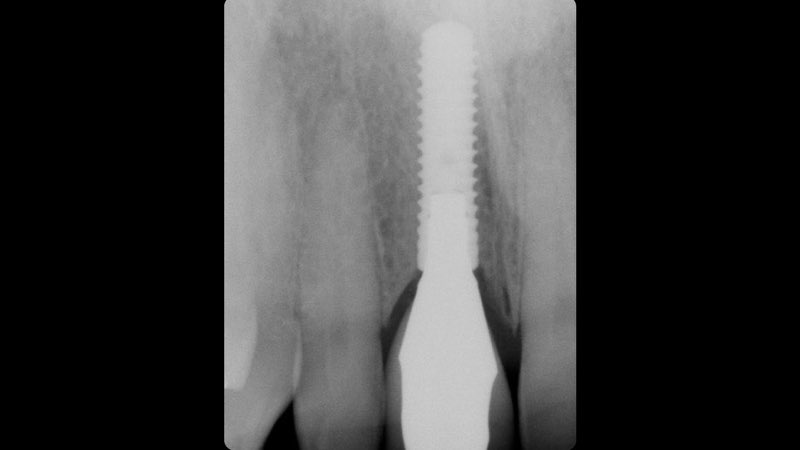 X-ray of tooth after dental implant restoration