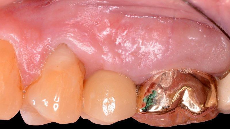 X-ray of smile with custom crafted dental crown