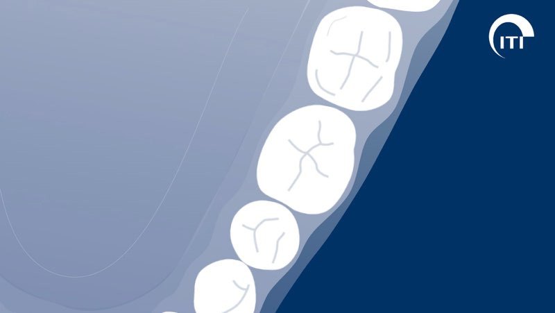 3 D animated rendering of damaged molar tooth