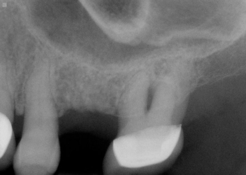 X-ray of smile with missing tooth