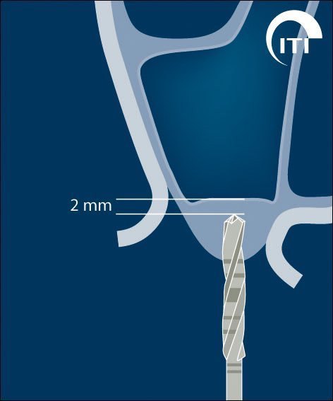 3 D surgical guide for dental implant placement