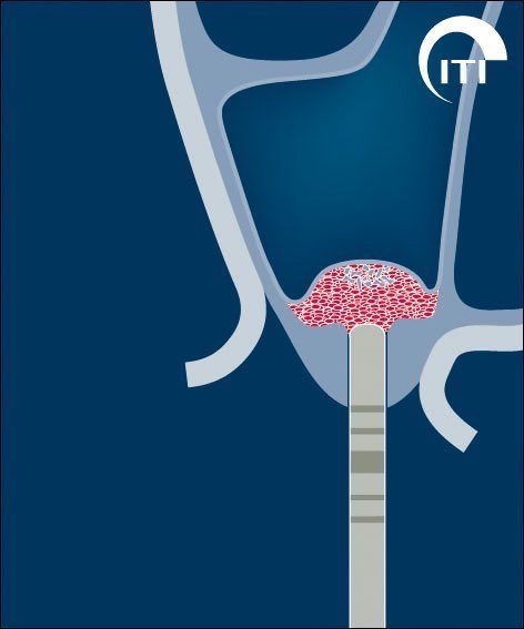 Animated bone graft placement