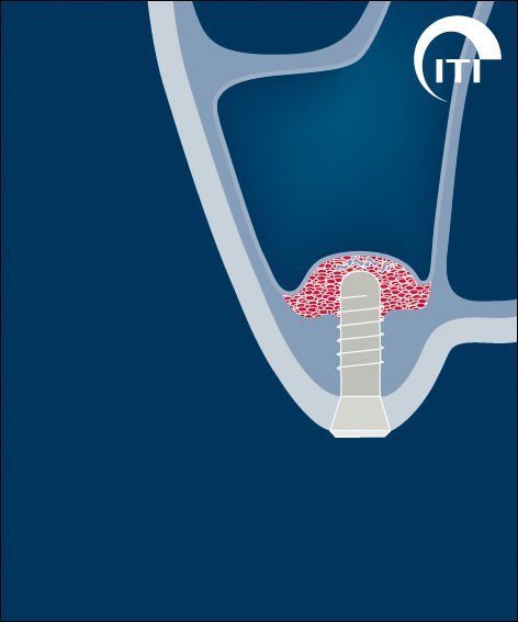 Animated dental implant placed in bone graft