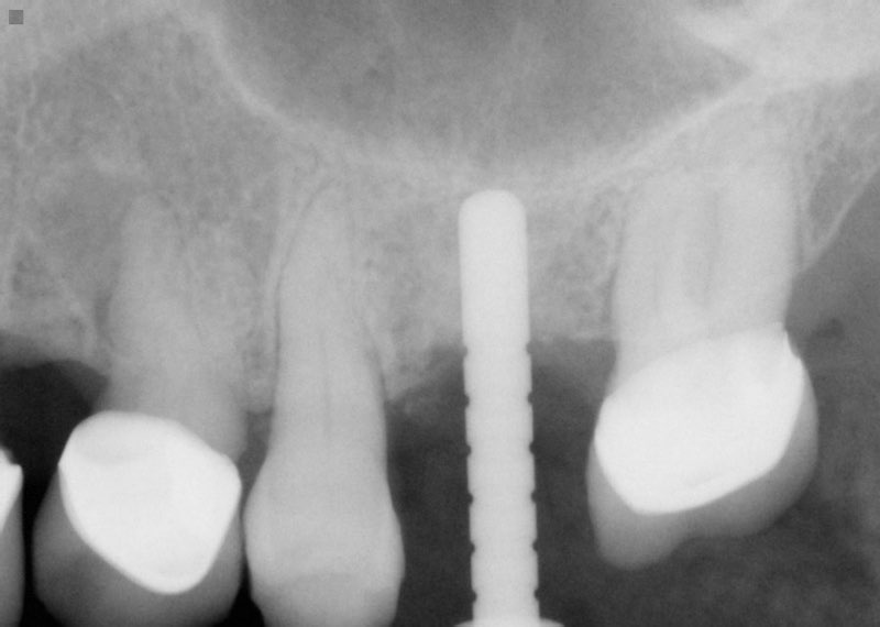 X-ray of smile with dental implant post