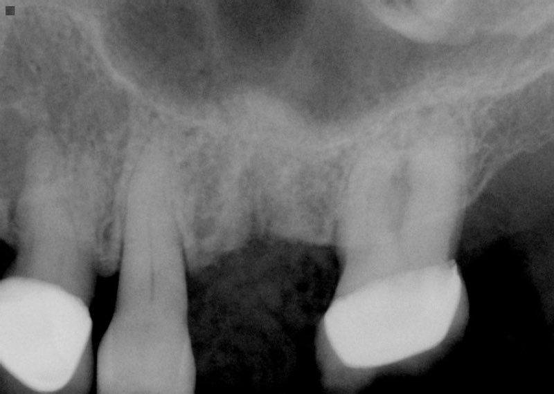 X-ray of smile after sinus lift bone graft