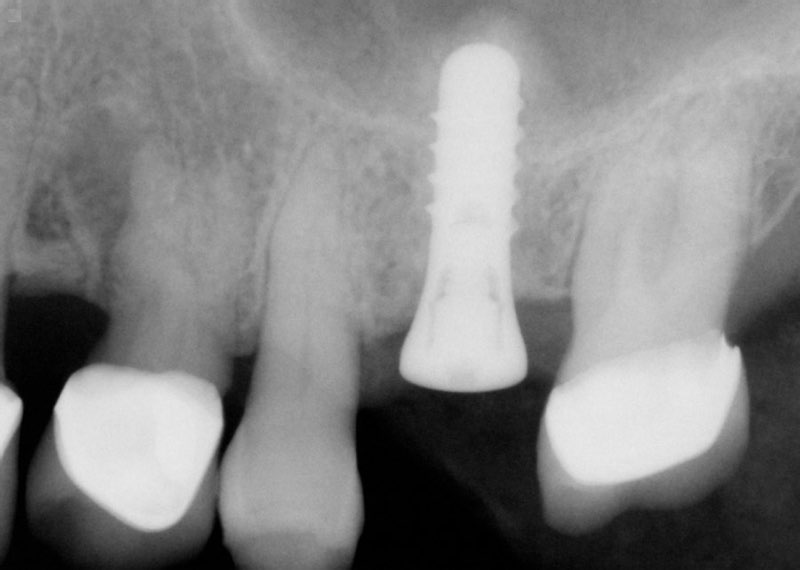 Smile with dental implant in place