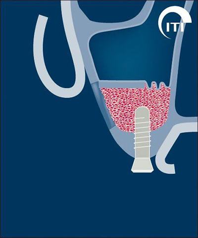 Animated rendering of bone graft and dental implant placement
