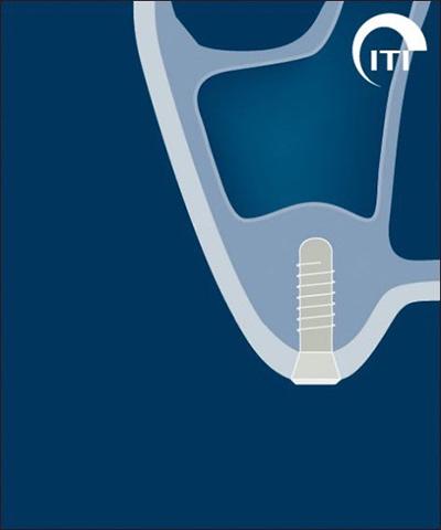 3 D rendering of dental implant post after healing