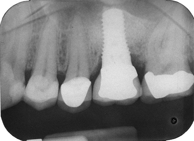 X-ray of dental implant supported replacement tooth