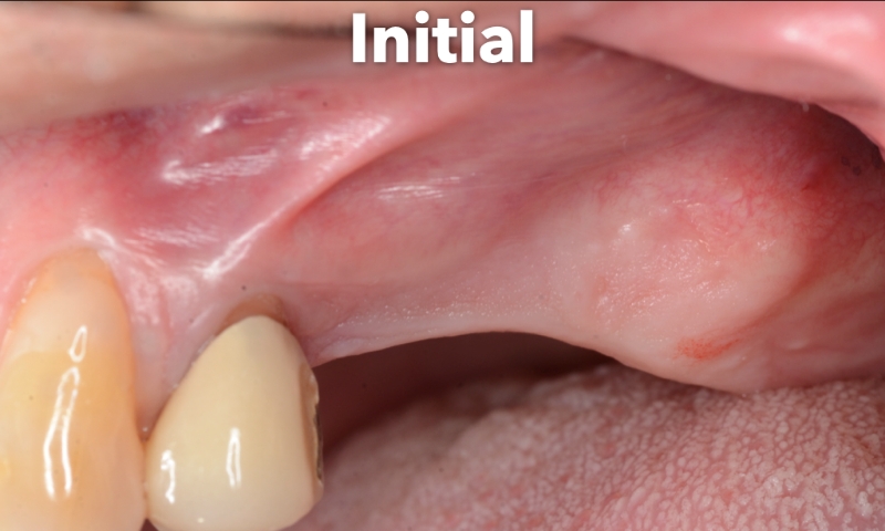 Animated rendering of dental implant site prior to implant placement
