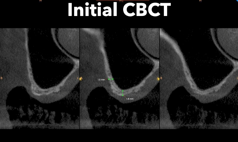 Animated rendering of dental implant site prior to implant placement