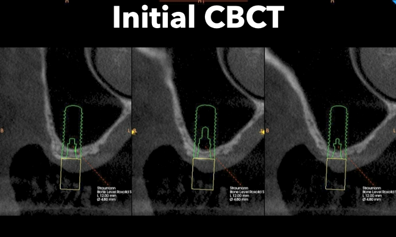 Animated rendering of dental implant site prior to implant placement