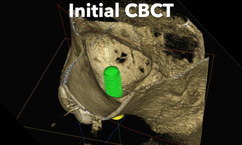Animated rendering of dental implant site prior to implant placement