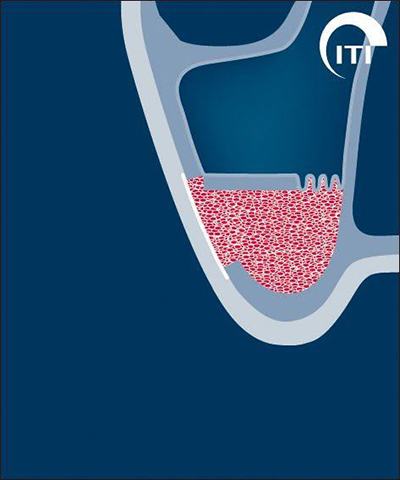 Animated rendering of smile with bone graft in place