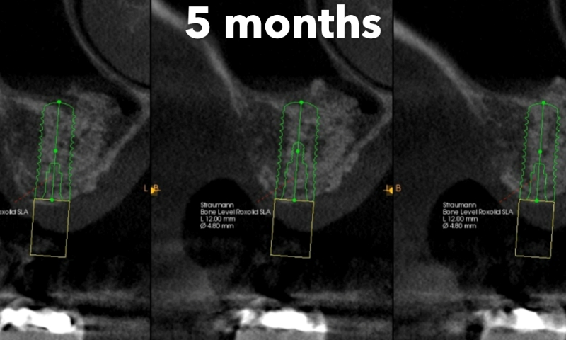 Animated rendering of dental implant post in grafted bone tissue