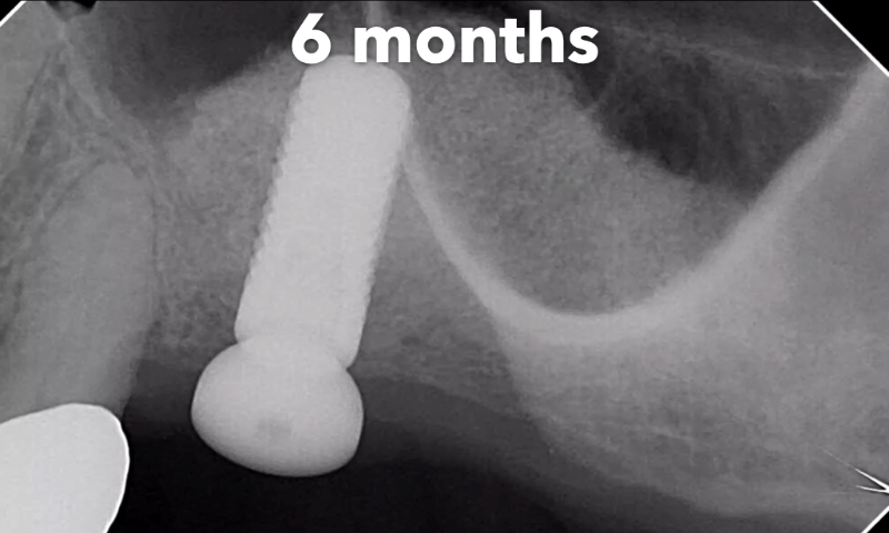 Animated rendering of dental implant post in grafted bone tissue