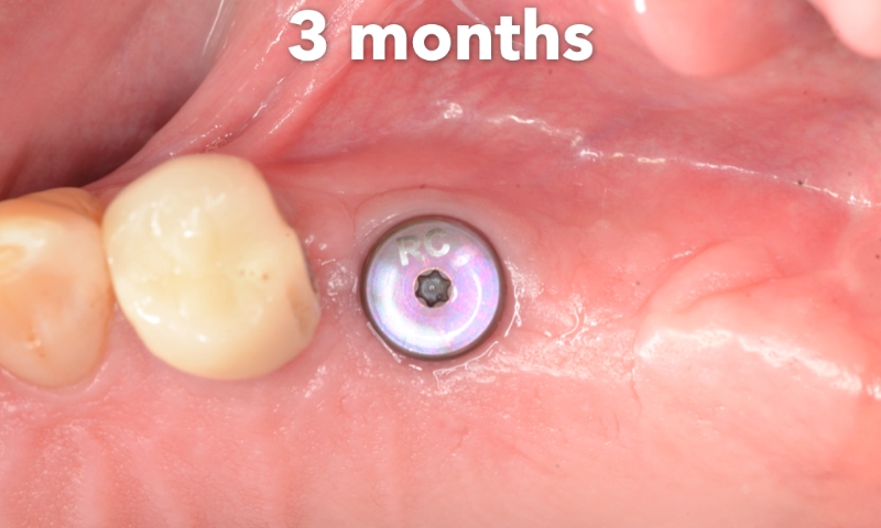 Animated rendering of dental implant post in grafted bone tissue