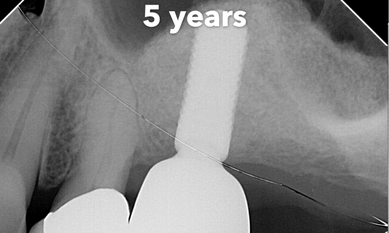 Animated rendering of dental implant post in grafted bone tissue