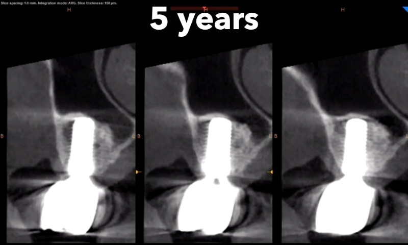 Animated rendering of dental implant post in grafted bone tissue