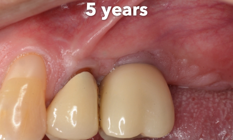 Animated rendering of dental implant post in grafted bone tissue
