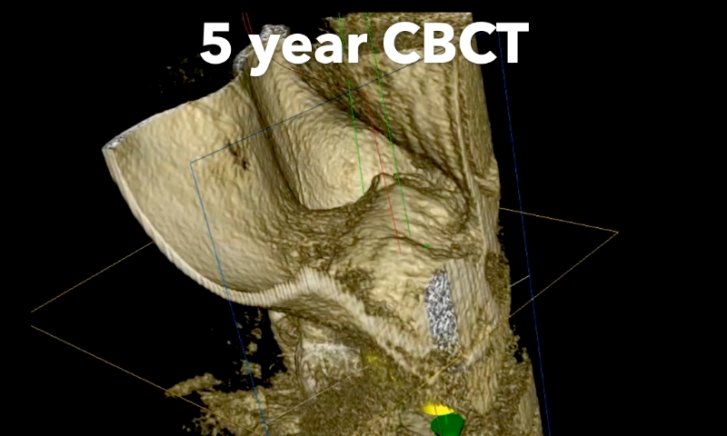 Animated rendering of dental implant post in grafted bone tissue