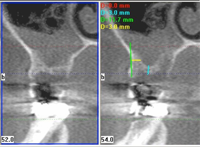 3 D C T scan of dental implant site