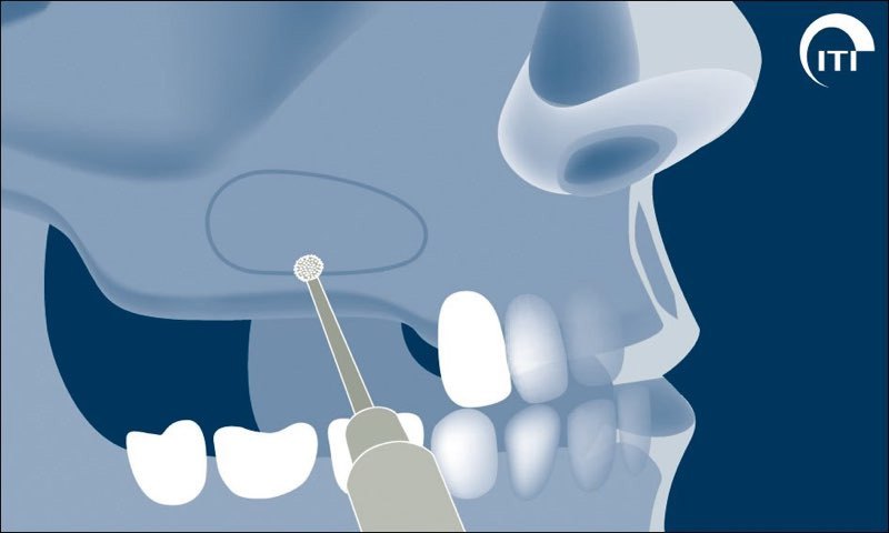 Animated rendering showing outline of the sinus