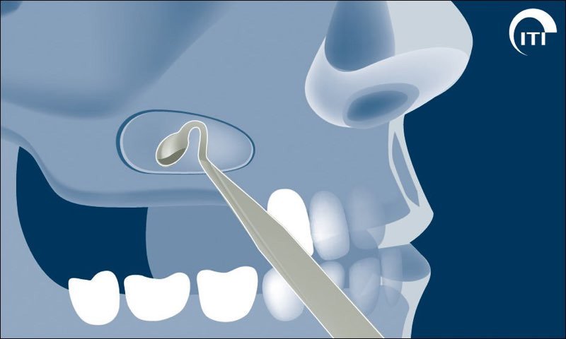 Animated rendering of sinus lift process