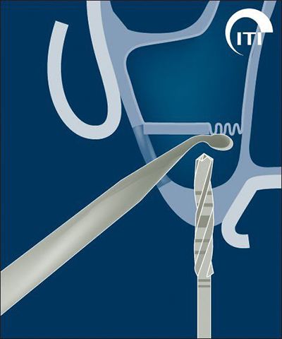 Animated rendering of preparation of the dental implant site