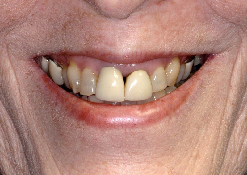Smile with dental damage and gum tissue recession