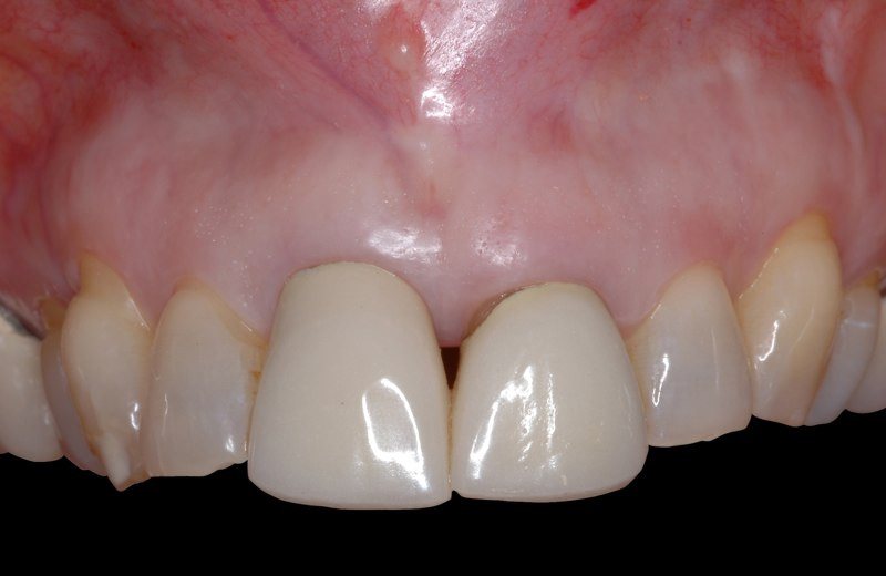 Smile with gum tissue recession before papilla augmentation grafting