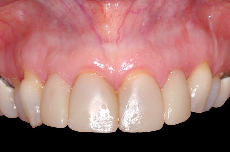 Closeup of smile after papill augmentation and temporary dental crowns to repair teeth