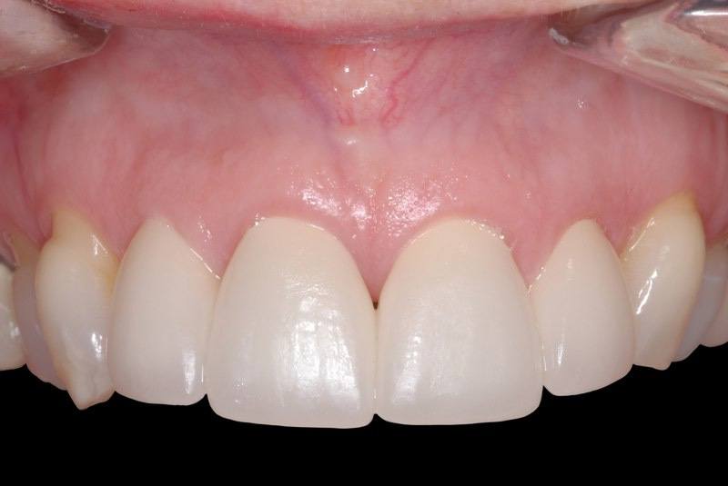 Closeup of healthy smile after papilla augmentation tissue grafting