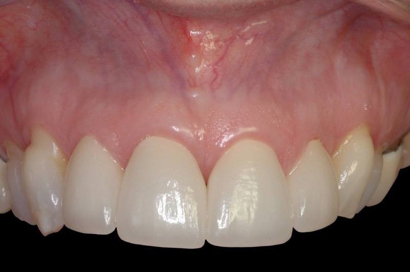 Healthy smile six months after papilla augmentation and dental restoration