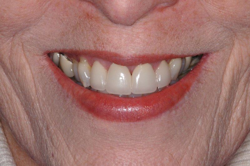 Patient's final smile after papilla augmentation and dental restoration