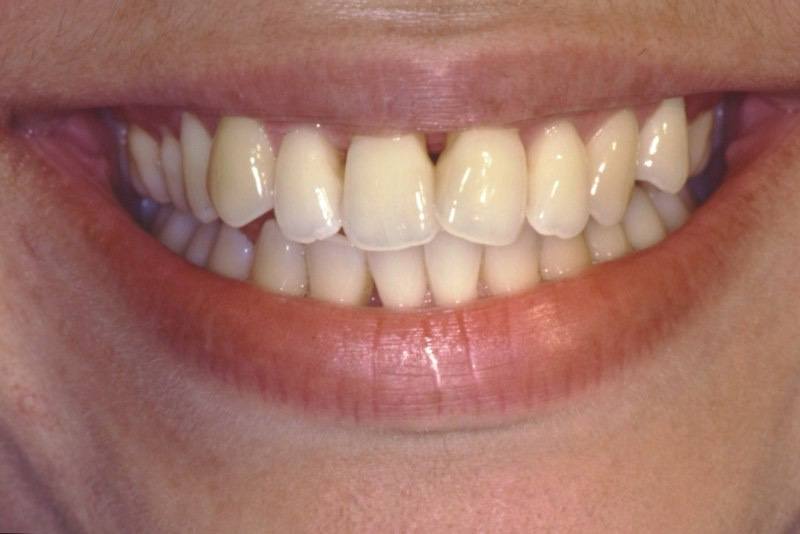 Initial smile showing triangular spaces at the tops of teeth