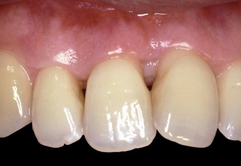 Closeup of smile showing triangular spacing at the top of teeth