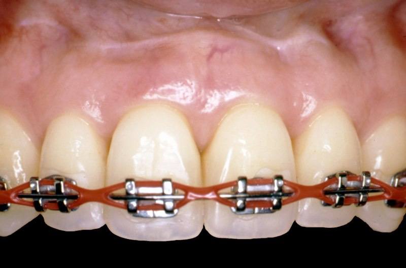 Patient after tissue graft receiving orthodontic treatment