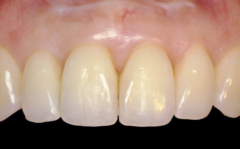 Smile after grafting and orthodontic treatment