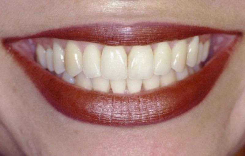 Patient's healthy smile several years after treatment