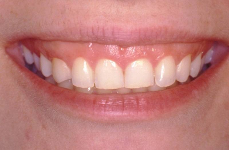 Smile before aesthetic gum recontouring