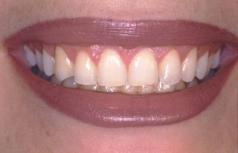 Smile after aesthetic gum recontouring