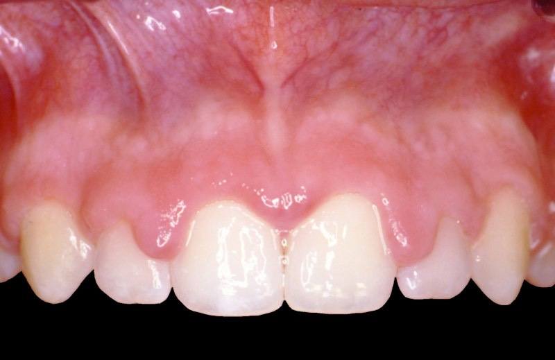 Closeup of uneven smile line before aesthetic gum recontouring