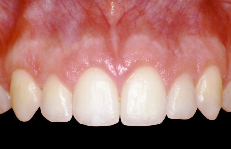 Gorgeous smile after aesthetic gum recontouring