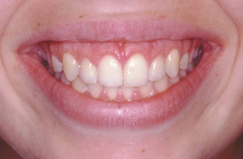 Closeup of smile after aesthetic gum recontouring