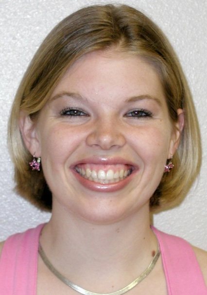 Patient smiling several years after aesthetic gum recontouring