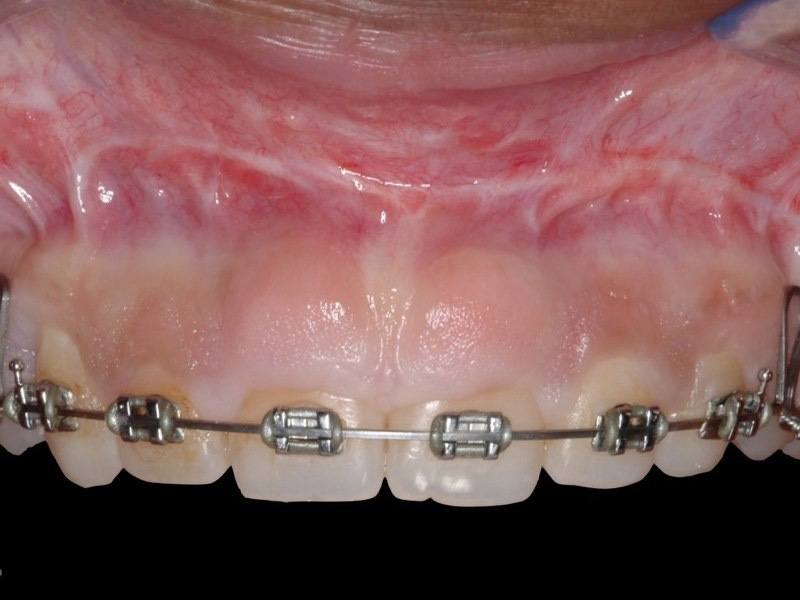 Closeup of smile before aesthetic gum recontouring