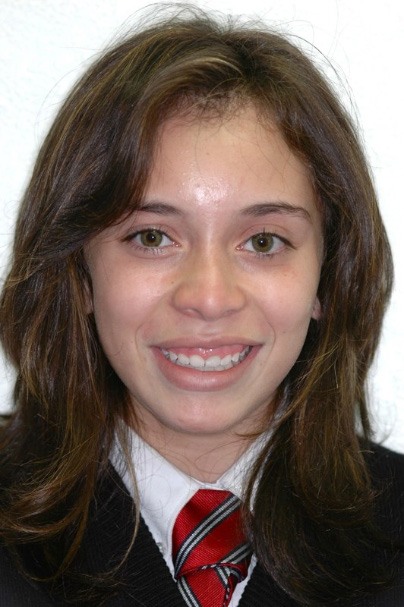 Patient smiling before aesthetic gum recontouring