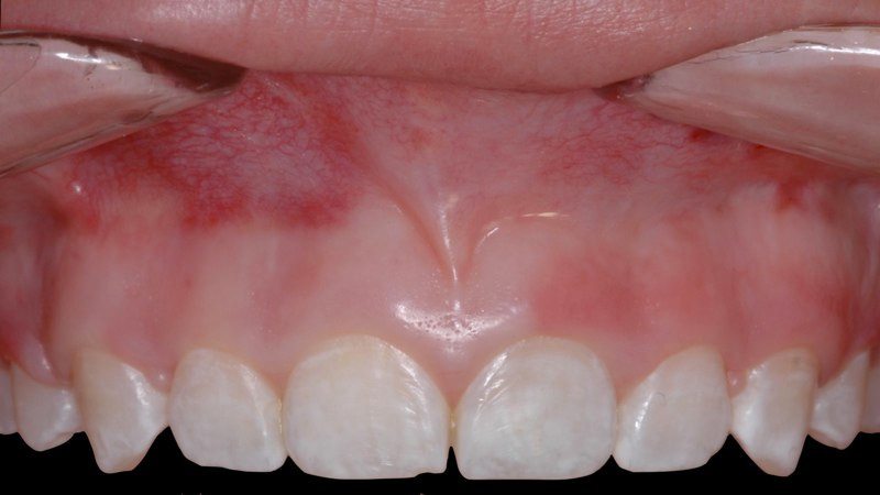 Closeup of smile before aesthetic gum recontouring